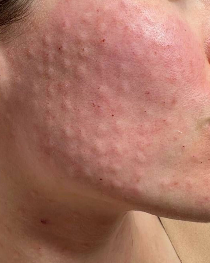 스킨부스터,리쥬란,연어주사 주입 시술 후 피부 모습